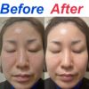 ミスタイトを使用しての、顔のビフォーアフターです。